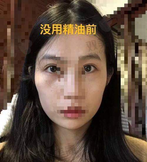 眼窝填充的潜在风险