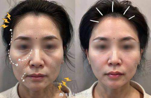 做赫莱丽玻尿酸会不会有副作用？只要医生靠谱，基本零风险