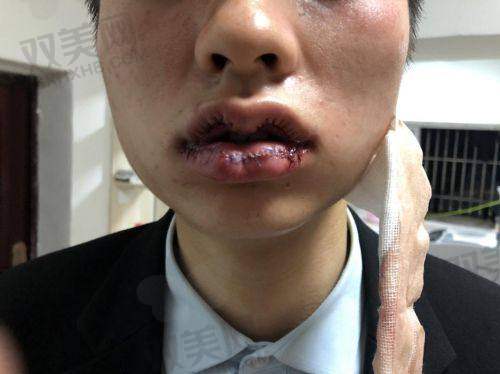 术后修复