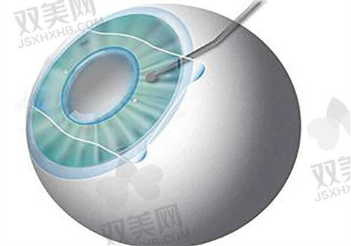 北京普瑞华德眼科医院价格表：全飞秒22800起，医保定点更放心