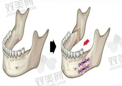 【韩国Faceline整形外科是正规的吗】