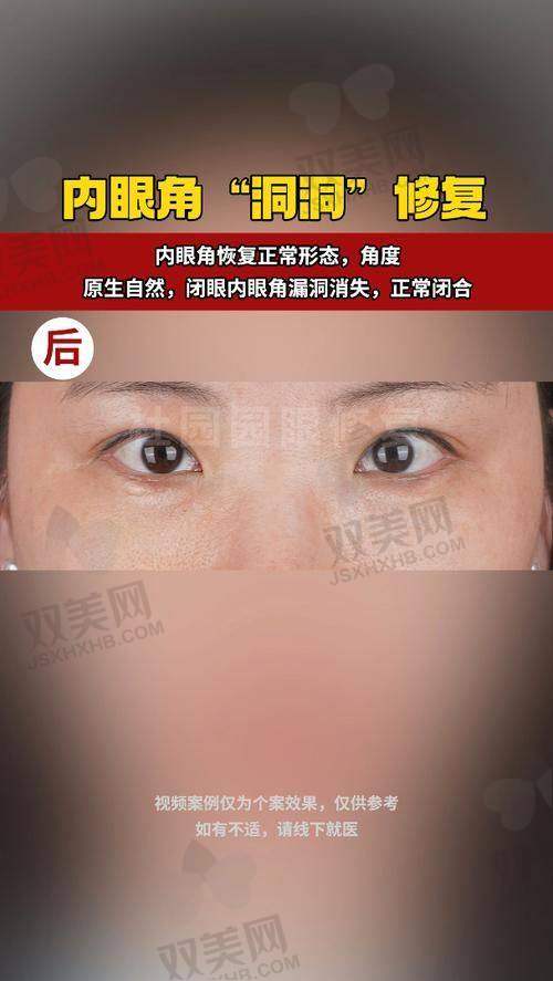 双眼皮修复的十大杰出医生排名