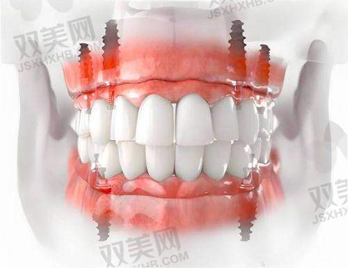 沈阳牙元素口腔医院收费标准大公开，种植牙、牙冠等项目性价比超高！