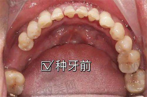 诺贝尔种植牙使用寿命有多久