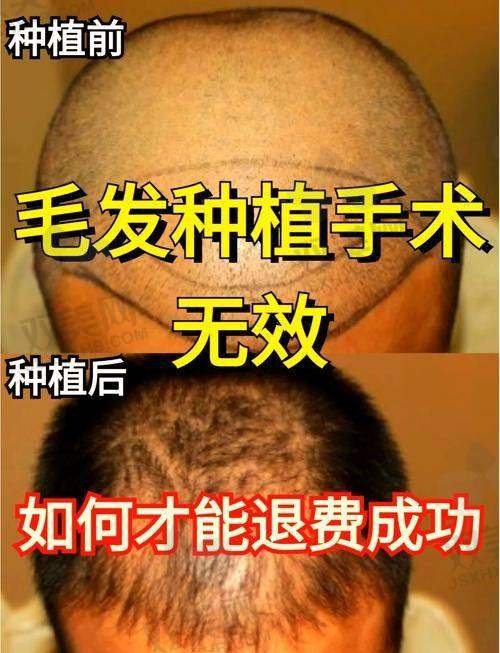 【韩国毛多毛毛发移植（原布莱克）医院技术特点】