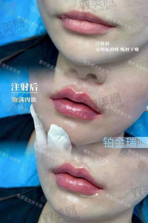 德彩玻尿酸到底分几号？每号适合哪里？