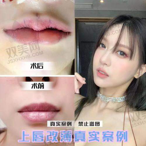 七、写在最后：别以为成人唇腭裂不能补，国家现在比你还急着帮你省