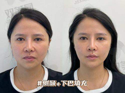 如何选择适合自己的面部填充整形方案