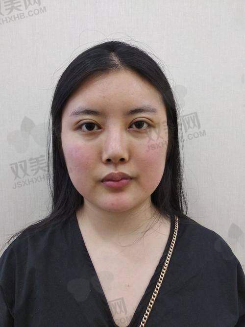 影响面部填充整形价格的因素