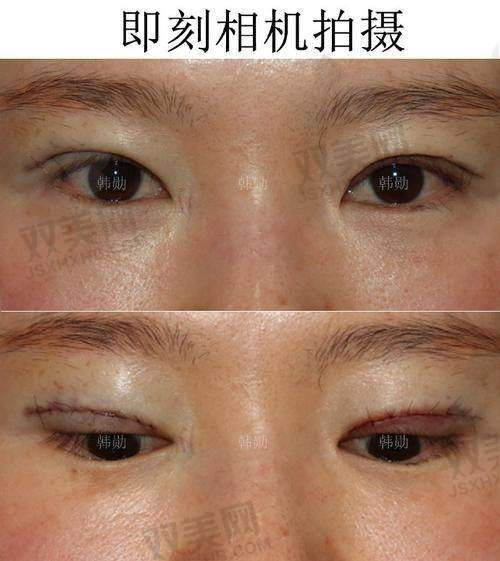 术前纠结与选择