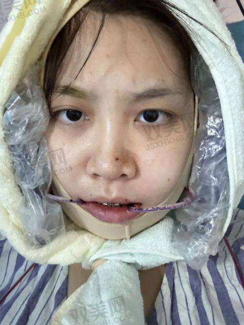 1）侧脸照片怎么看嘴凸类型？