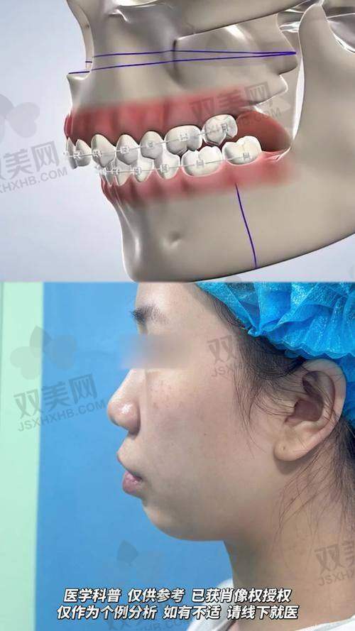 2）X光片一拍，真假“凸嘴”立判