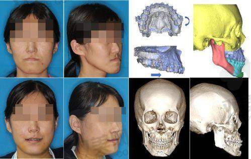 1）牙性嘴凸怎么治？
