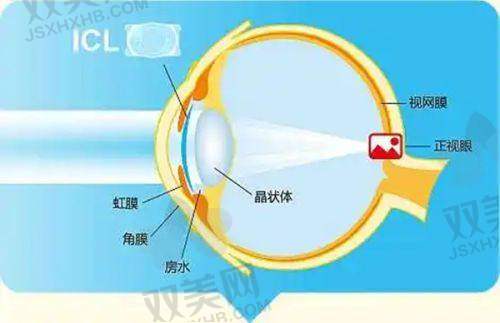 探讨薛安全缩眼轴成效，对比段安丽排名及费用情况