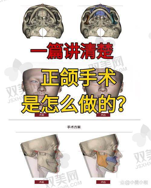 何照华做下颌角，会不会切得太狠？