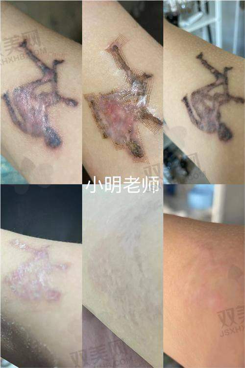 凹陷疤痕脂肪填充的修复时间