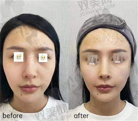眼窝填充术大概要多少钱