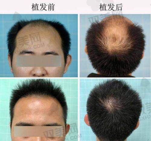 【广州美恩医疗美容医院植发科电话号码是多少】