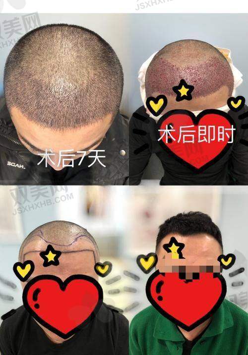 【广州美恩医疗美容医院植发科擅长什么项目】