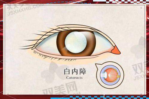 一、政策来了！抚顺人做白内障手术也能“0元”搞定？YES！