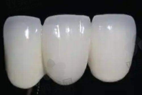 补牙费用是多少？