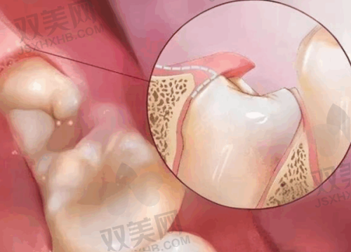 植牙一颗的医疗保险报销情况