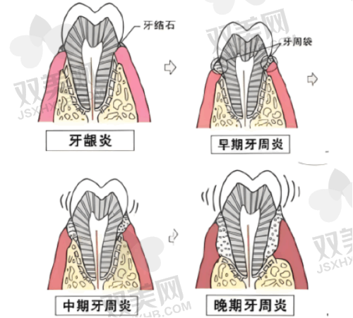 种植全口假牙费用与成效的平衡