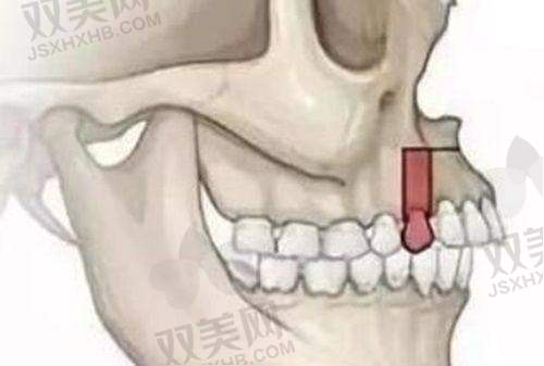 牙槽骨条件不佳