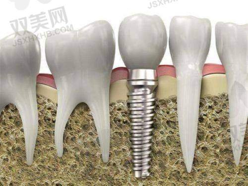 单颗牙缺失患者