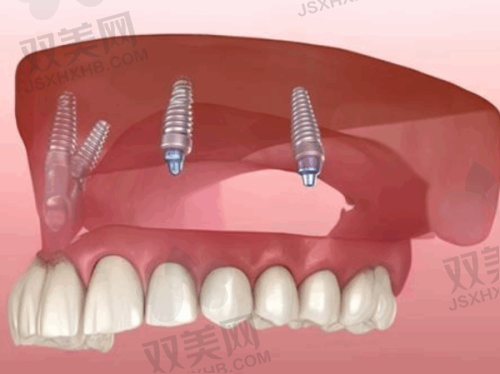 种植手术后的注意事项