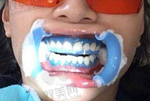 牙齿不好的护理调理修复方法