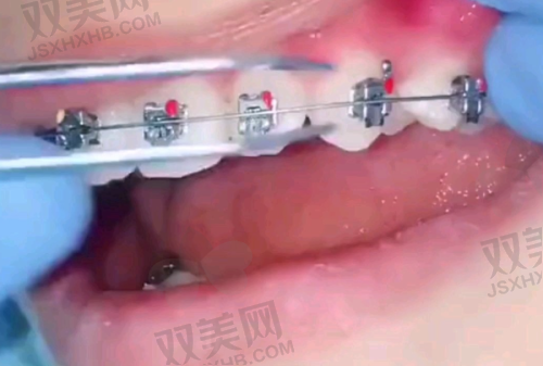 多颗牙缺失患者