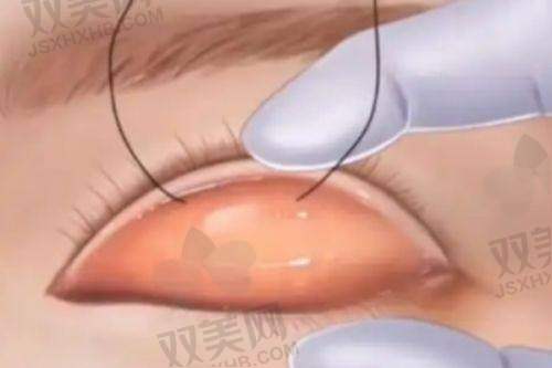 综合傲诺拉隆胸图片的选择建议