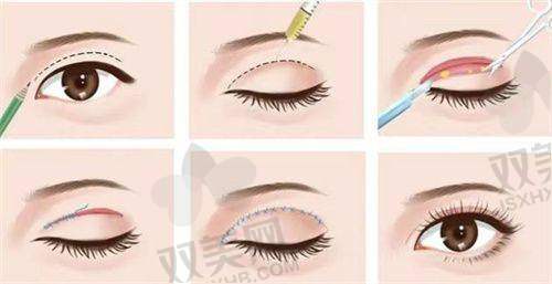 成都新丽美整形医疗美容医院游晓波医生做下睑袋矫正术(外切)13500元起,祛脂紧肤综合改善