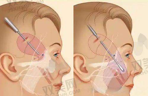 傲诺拉隆胸图片反映的材料质量