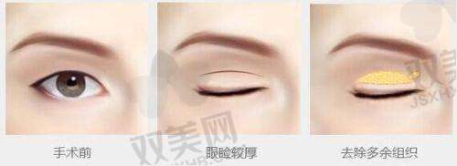 花14500找成都新丽美游晓波做内眦赘皮矫正术后修复，疤痕粘连全搞定！