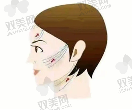 成都新丽美陈再洪医生做耳轮脚成形术【7500元起】,细微结构调整与形态优化一步到位