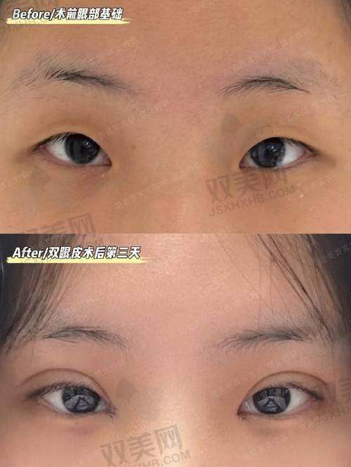 三、美杜莎综合美眼术到底是啥？我来浅科普