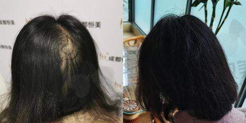 【深圳悦尔医疗美容医院植发科擅长什么项目】
