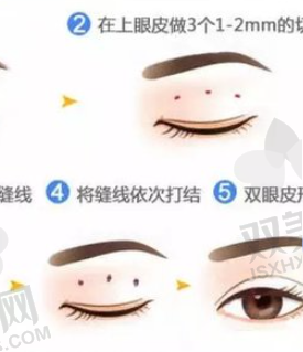 亲测成都新丽美游晓波外眦开大术，13500元起，精准切开术后效果自然超满意