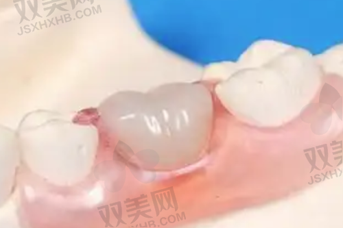 补牙洞的治疗次数与时间