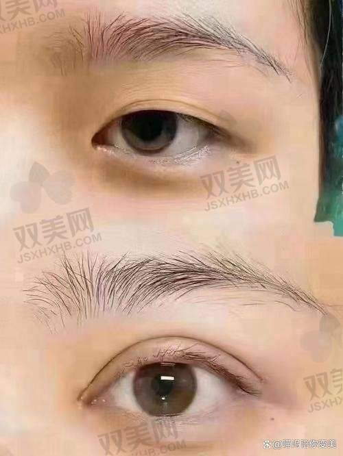 术前纠结与了解
