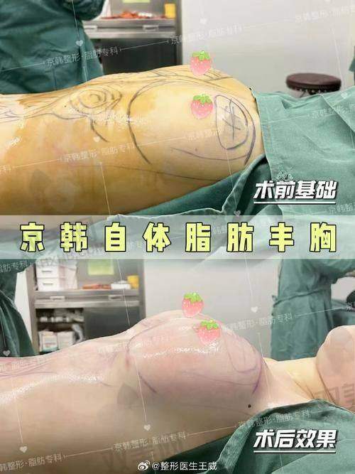 傲诺拉隆胸后多久可以洗澡