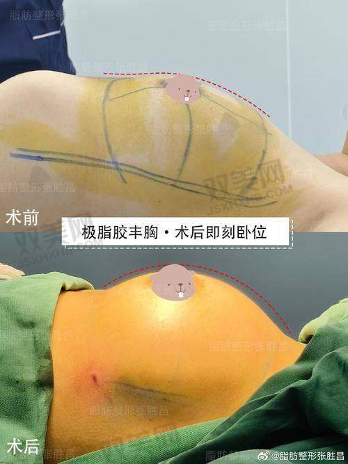 美国傲诺拉假体的维持年限