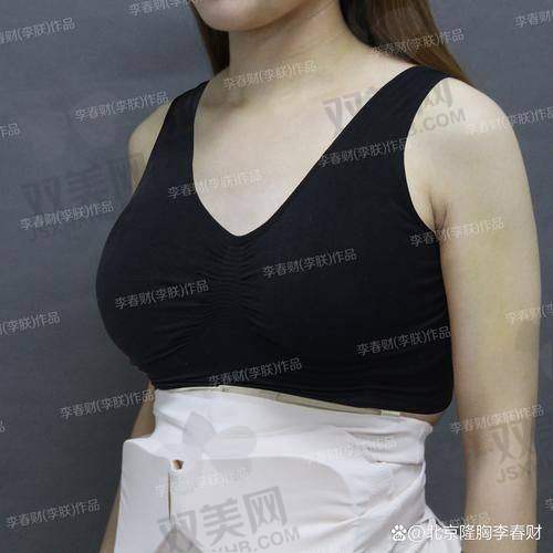 傲诺拉隆胸大小的选择方法