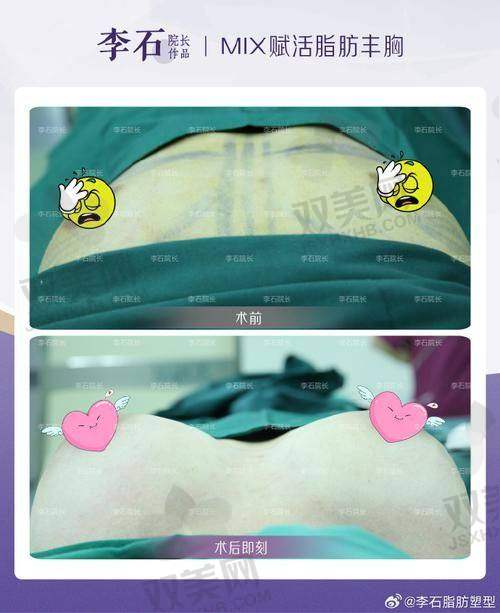 傲诺拉璀璨假体隆胸安心性如何