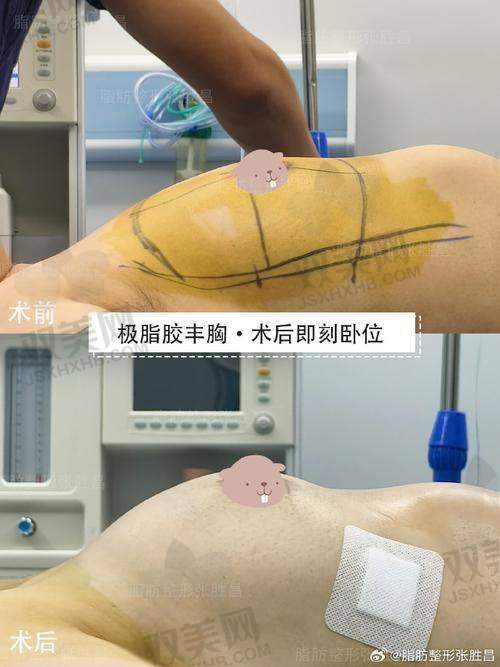 傲诺拉假体隆胸价格差异原因