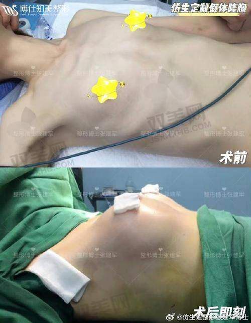傲诺拉隆胸与其他隆胸方式手感对比