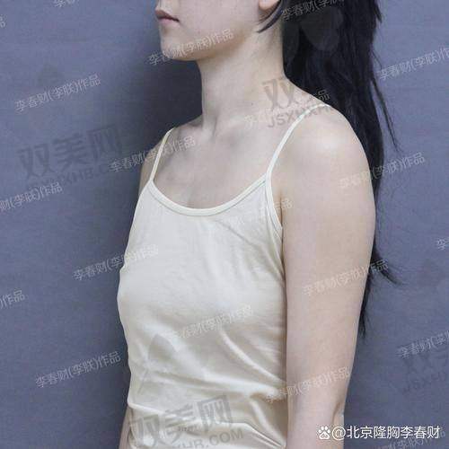 傲诺拉隆胸假体质量保护