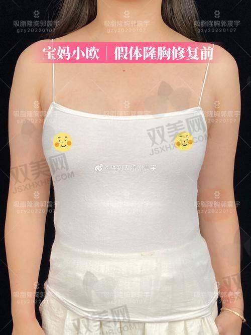 傲诺拉隆胸的价格因素